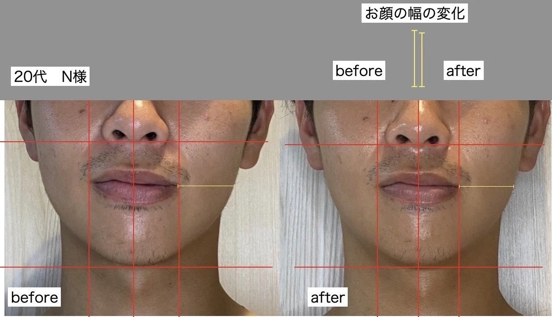 フェイシャルのビフォーアフター写真